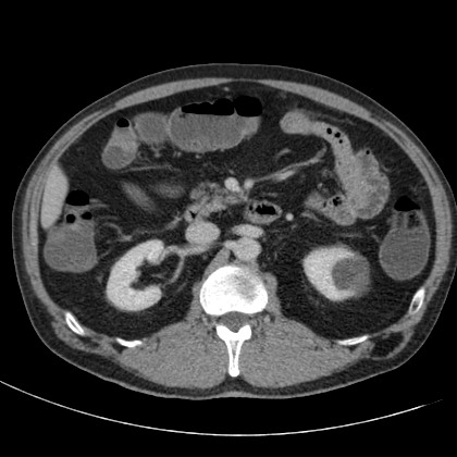 Acute appendicitis (Radiopaedia 66513-75790 Axial C+ portal venous phase 25).jpg