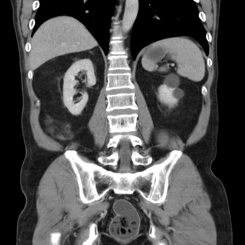 File:Acute appendicitis (Radiopaedia 66513-75790 Coronal C+ portal venous phase 62).jpg