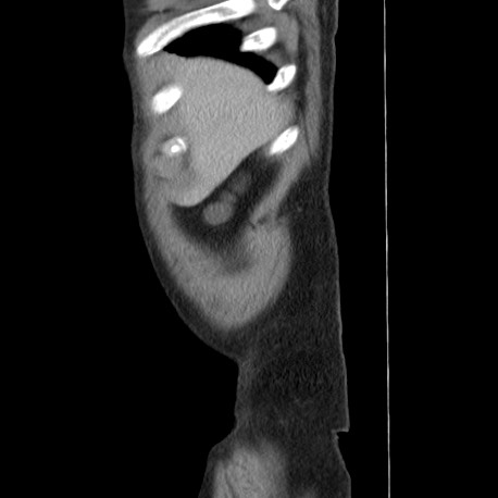 Acute appendicitis (Radiopaedia 66513-75790 Sagittal C+ portal venous phase 3).jpg