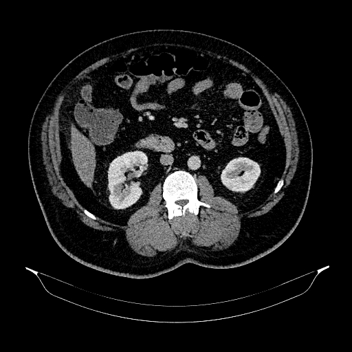 Acute appendicitis (Radiopaedia 79950-93224 Axial C+ portal venous phase 49).jpg