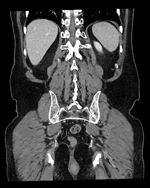 Acute appendicitis - large appendicoliths (Radiopaedia 61805-69820 Coronal C+ portal venous phase 106).jpg