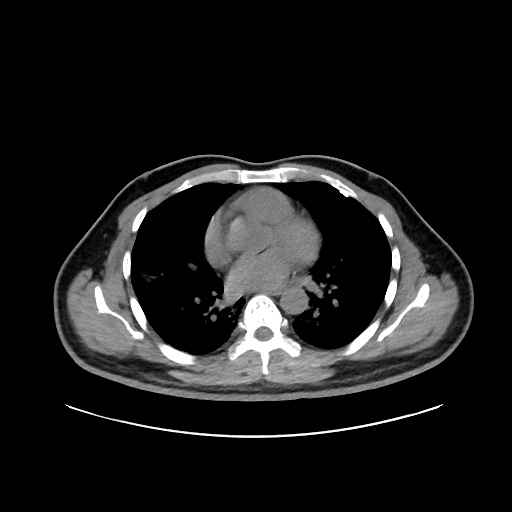 Acute appendicitis and COVID 19 pneumonia (Radiopaedia 76604-88380 Axial non-contrast 30).jpg