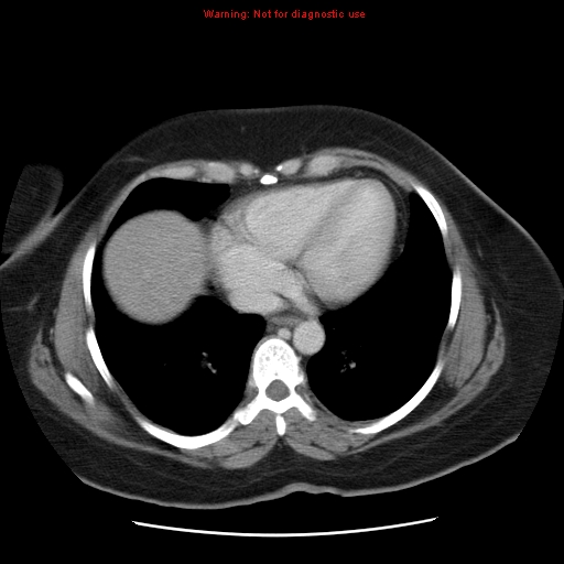 Acute appendicitis complicated by ovarian vein thrombophlebitis (Radiopaedia 16172-15851 Axial C+ portal venous phase 11).jpg