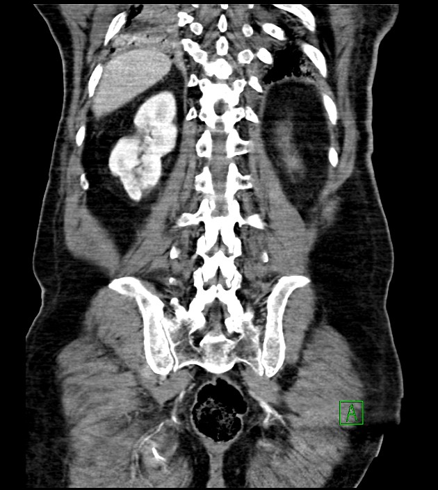 Acute arterial mesenteric ischemia (Radiopaedia 78238-90828 Coronal C+ portal venous phase 72).jpg