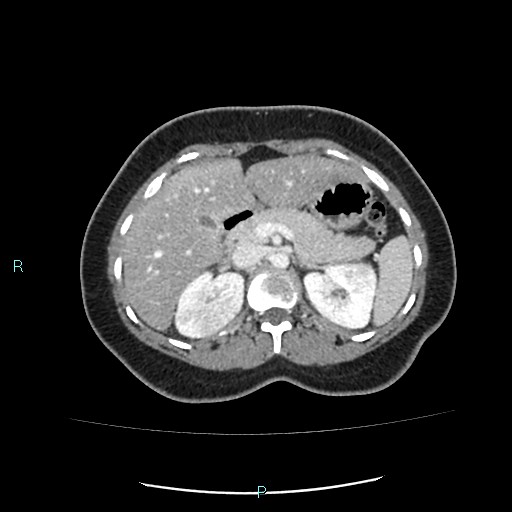 Acute bilateral pyelonephritis (Radiopaedia 37146-38881 Axial C+ portal venous phase 34).jpg