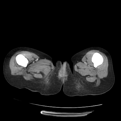 Acute calculous cholecystitis in patient with osteopetrosis (Radiopaedia 77871-90159 Axial C+ portal venous phase 88).jpg