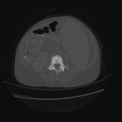 File:Acute calculous cholecystitis in patient with osteopetrosis (Radiopaedia 77871-90159 Axial bone window 29).jpg