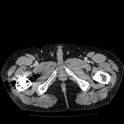 File:Acute cholecystitis and incidental left sided IVC (Radiopaedia 49352-54459 Axial C+ portal venous phase 168).jpg