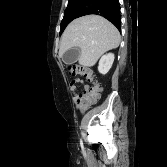 Acute cholecystitis and incidental left sided IVC (Radiopaedia 49352-54459 Sagittal C+ portal venous phase 68).jpg