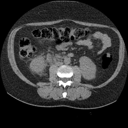 File:Acute cholecystitis and ureteric colic (Radiopaedia 42330-45444 Axial prone 52).jpg