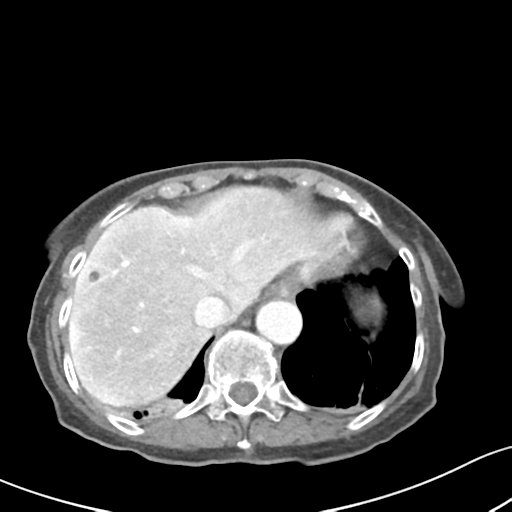 Acute cholecystitis with contained perforation (Radiopaedia 47328-51907 Axial C+ portal venous phase 12).png