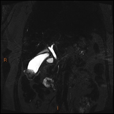 File:Acute cholecystitis with gallbladder neck calculus (Radiopaedia 42795-45971 Coronal Turbo spin echo 25).jpg