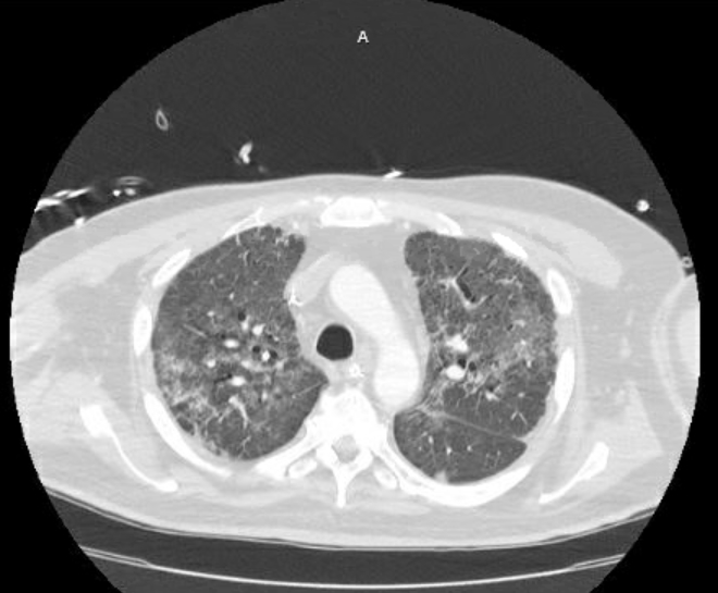 File:Acute cor pulmonale (ultrasound) (Radiopaedia 83508-98818 Axial lung window 28).jpg