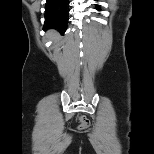 Acute diverticulitis with localized perforation (Radiopaedia 41296-44113 Coronal C+ portal venous phase 54).jpg