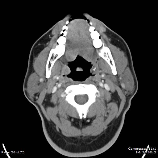 Acute epiglottitis (Radiopaedia 54375-60590 Axial C+ arterial phase 26).jpg
