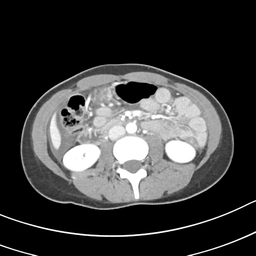 Acute gangrenous appendicitis with perforation (Radiopaedia 40152-42662 Axial C+ portal venous phase 33).png