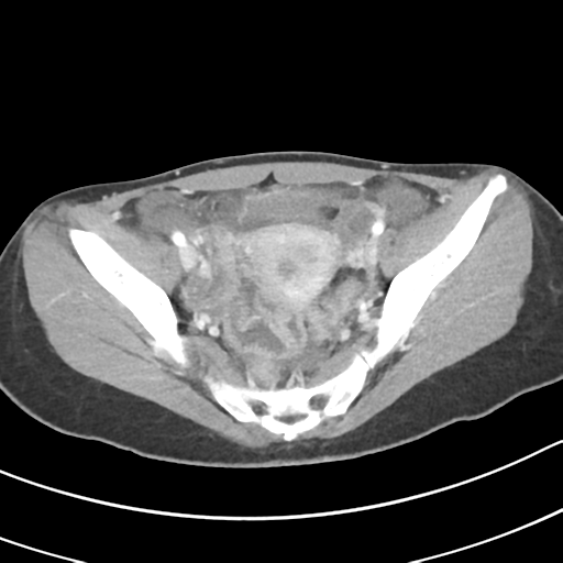 Acute gangrenous appendicitis with perforation (Radiopaedia 40152-42662 Axial C+ portal venous phase 61).png