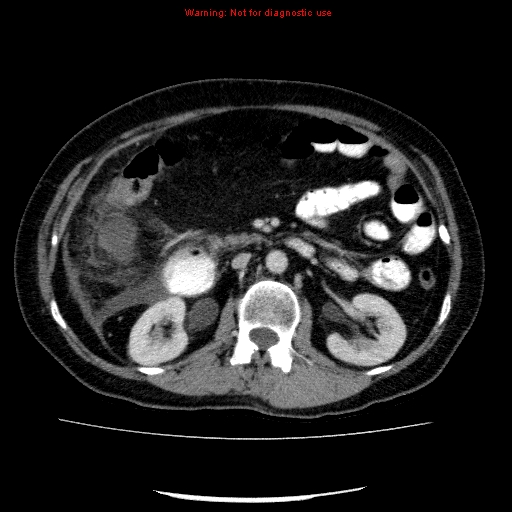 Acute gangrenous cholecystitis (Radiopaedia 10123-10661 Axial C+ portal venous phase 43).jpg