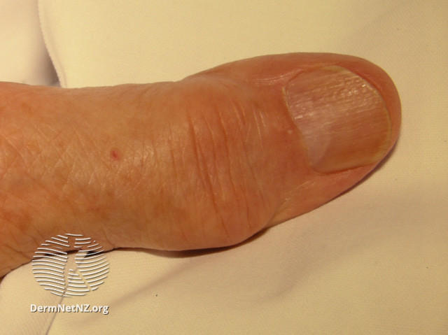 File:Acute gout (DermNet NZ systemic-gout4).jpg