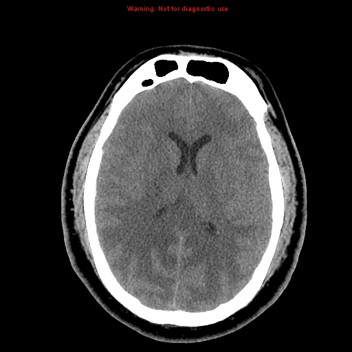 File:Acute hemorrhagic leukoencephalitis (Radiopaedia 14076-13920 Axial non-contrast 28).jpg