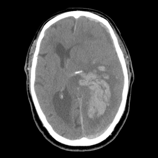 Acute hemorrhagic stroke (Radiopaedia 17507-17223 Axial non-contrast 27).jpg