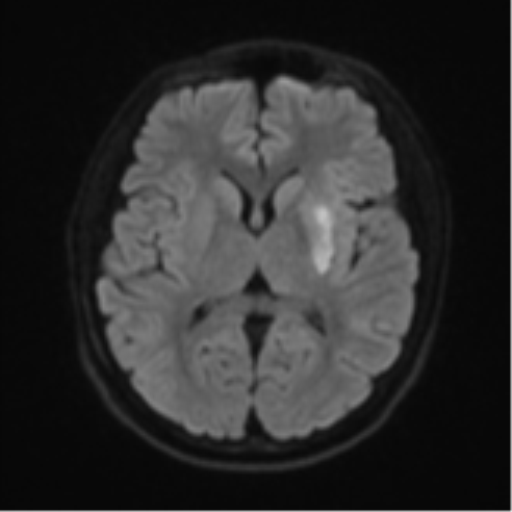 Acute left middle cerebral artery territory infarct with clot retrieval (Radiopaedia 47732-52433 Axial DWI 46).png