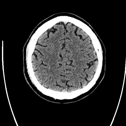 Acute left middle cerebral artery territory ischemic stroke (Radiopaedia 35688-37223 Axial non-contrast 63).png