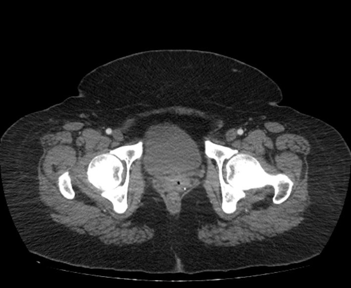 Acute mesenteric ischemia (Radiopaedia 80029-93316 Axial C+ arterial phase 131).jpg