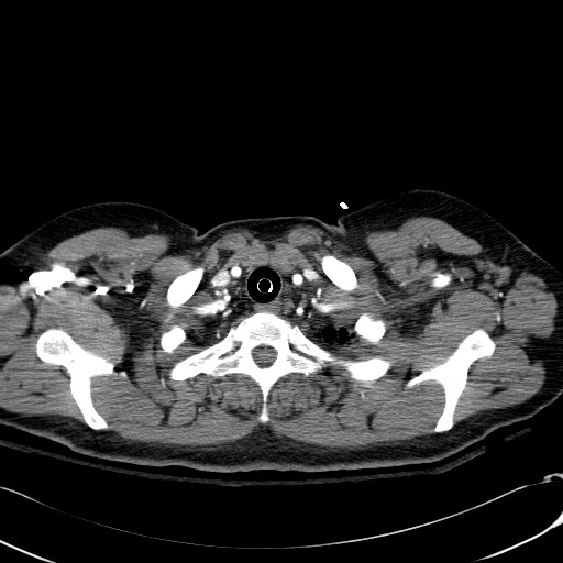 Acute myocardial infarction in CT (Radiopaedia 39947-42415 Axial C+ arterial phase 10).jpg