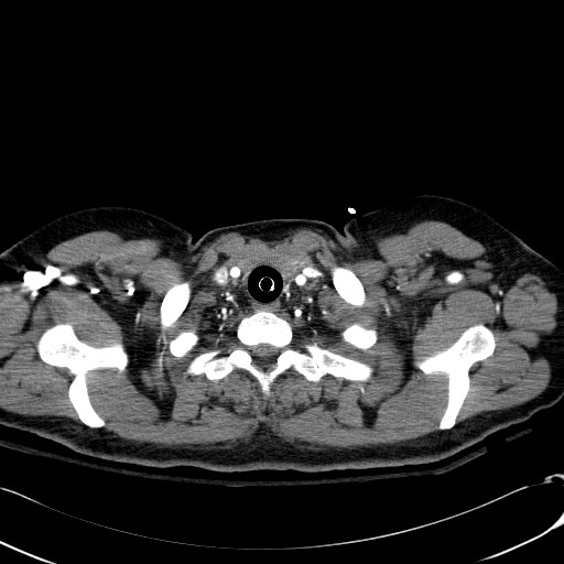Acute myocardial infarction in CT (Radiopaedia 39947-42415 Axial C+ arterial phase 7).jpg