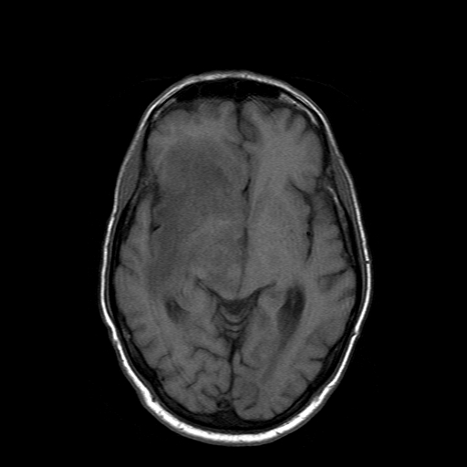 File:Acute necrotizing toxoplasma encephalitis (Radiopaedia 10683-11149 Axial T1 10).jpg