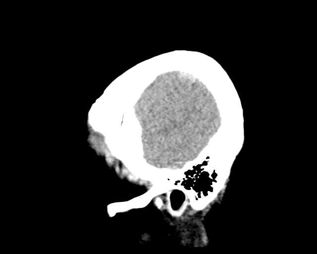Acute on chronic subdural hemorrhage (Radiopaedia 85330-100923 Sagittal non-contrast 13).jpg