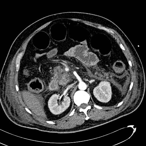 File:Acute pancreatic necrosis (Radiopaedia 13560-13486 Axial C+ portal venous phase 60).jpg