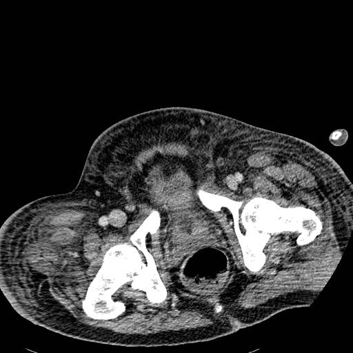 Acute pancreatic necrosis (Radiopaedia 13560-18501 Axial C+ portal venous phase 145).jpg