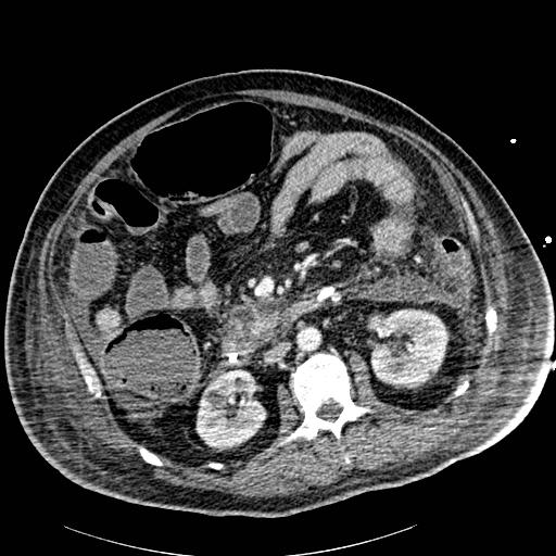 Acute pancreatic necrosis (Radiopaedia 13560-18502 Axial C+ portal venous phase 45).jpg