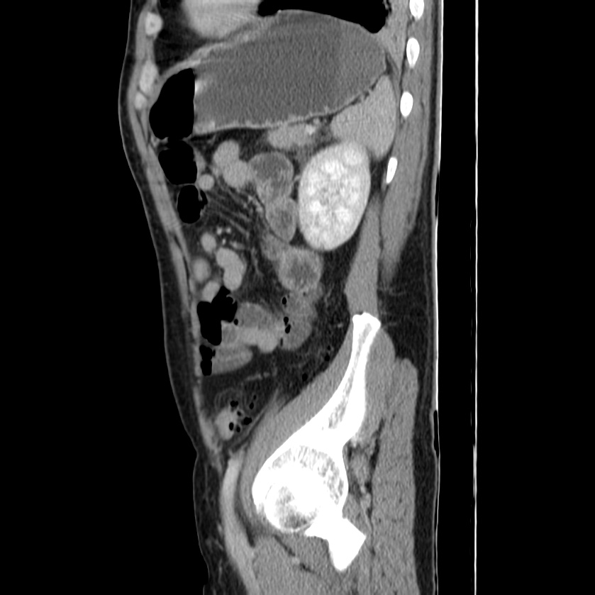 Acute pancreatitis (Radiopaedia 22572-22596 Sagittal C+ portal venous phase 41).jpg