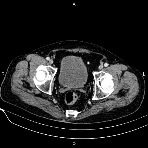 Acute pancreatitis (Radiopaedia 85146-100701 Axial C+ portal venous phase 59).jpg
