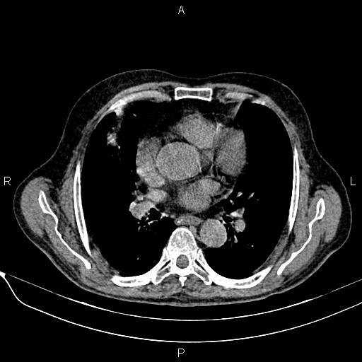 Acute pancreatitis (Radiopaedia 85146-100701 Axial non-contrast 6).jpg