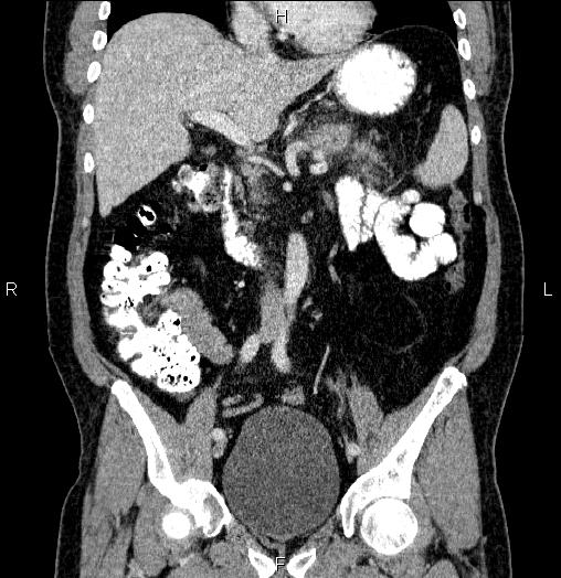 File:Acute pancreatitis (Radiopaedia 85390-101010 Coronal C+ portal venous phase 34).jpg