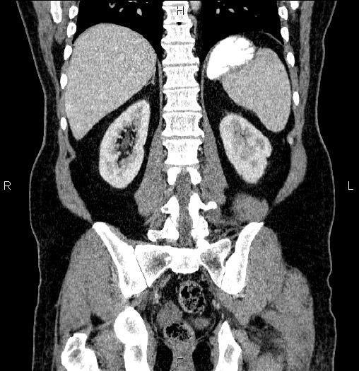 File:Acute pancreatitis (Radiopaedia 85390-101010 Coronal C+ portal venous phase 53).jpg