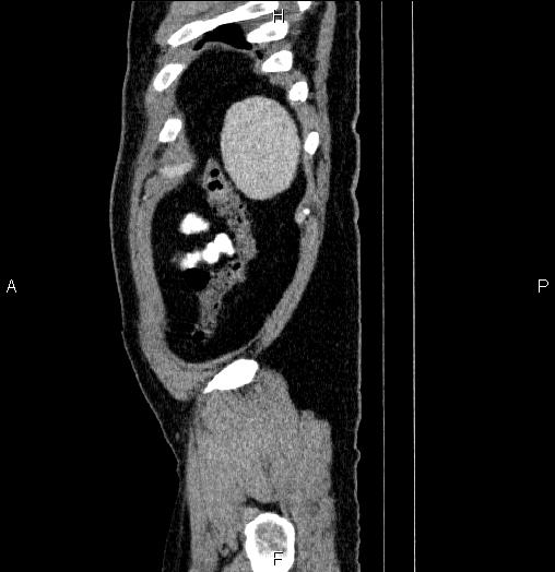 Acute pancreatitis (Radiopaedia 85390-101010 Sagittal C+ portal venous phase 98).jpg