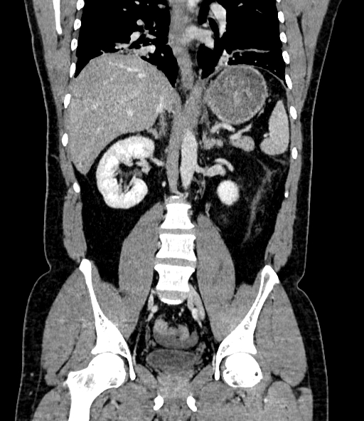 Acute pancreatitis (Radiopaedia 87428-103757 Coronal C+ portal venous phase 56).jpg