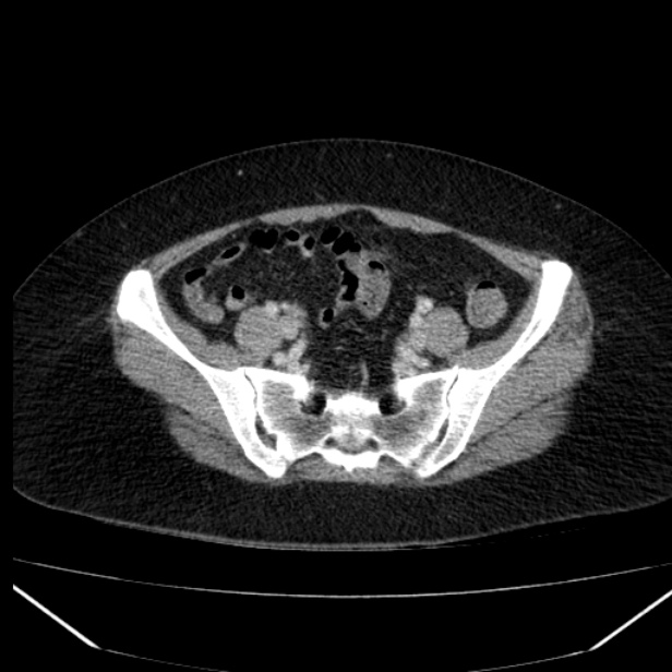 Acute pancreatitis - Balthazar C (Radiopaedia 26569-26714 Axial C+ portal venous phase 75).jpg