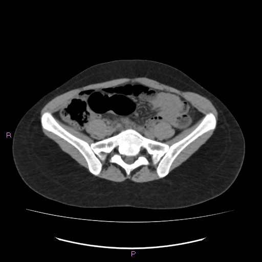 Acute pancreatitis secondary to stone at minor papilla and pancreatic divisum (Radiopaedia 76570-88333 Axial non-contrast 53).jpg