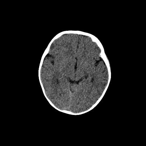Acute phase of hemiconvulsion-hemiplegia epilepsy syndrome (Radiopaedia 29309-29744 Axial non-contrast 30).jpg