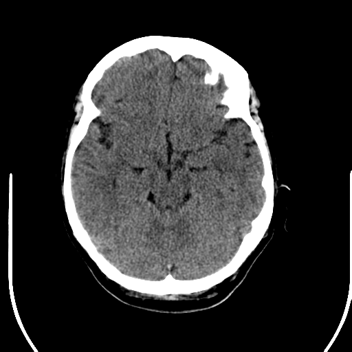 File:Acute pontine infarct from vertebral artery dissection (Radiopaedia 34111-35369 Axial non-contrast 10).png