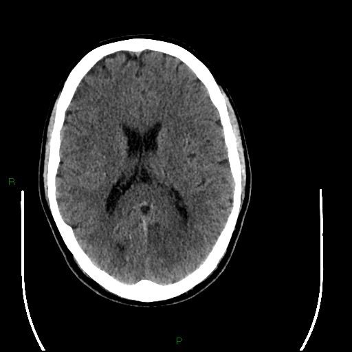 Acute posterior cerebral artery territory infarct (Radiopaedia 79329-92393 Axial non-contrast 62).jpg
