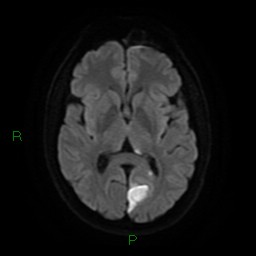 Acute posterior cerebral artery territory infarct (Radiopaedia 79329-92394 Axial DWI 15).jpg