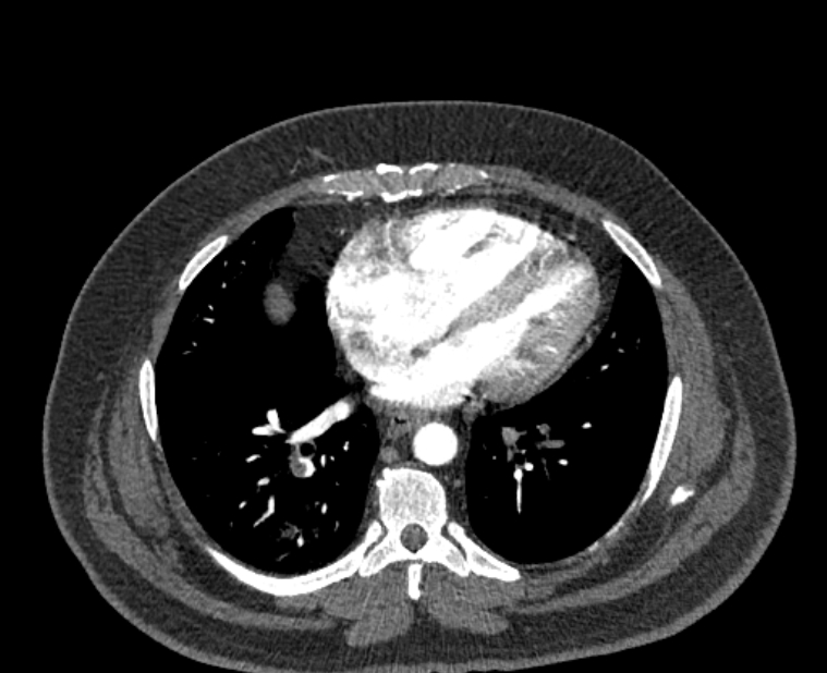 Acute pulmonary embolism with pulmonary infarcts (Radiopaedia 77688-89908 Axial C+ CTPA 43).jpg