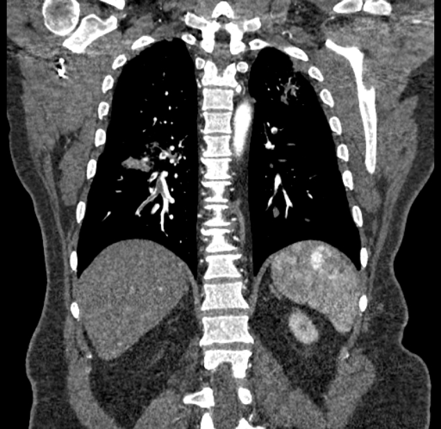 Acute pulmonary embolism with pulmonary infarcts (Radiopaedia 77688-89908 Coronal C+ CTPA 74).jpg